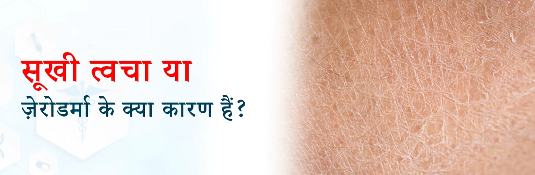  सूखी त्वचा या ज़ेरोडर्मा के क्या कारण हैं?